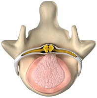 DISC HERNIATION